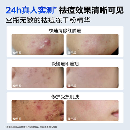 【根源祛痘】优理氏寡肽多效舒缓冻干粉 修护痘肌调理肌底 根源抑痘 改善痘印 商品图6