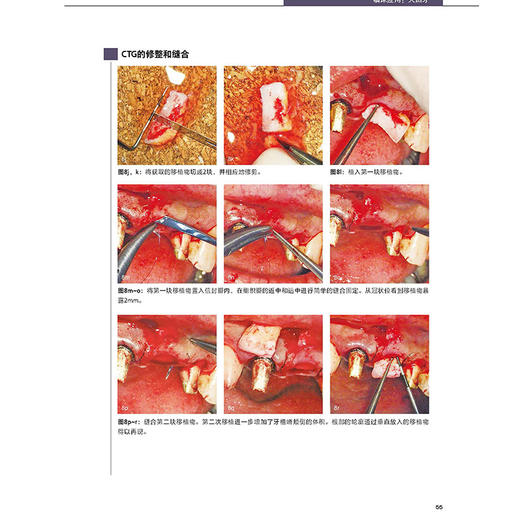 牙周显微外科高阶技术图解 理想的美学区软组织管理 铃木真名 高小波 赵阳 李军 译 牙周病口腔外辽宁科学技术出版社9787559136244 商品图4