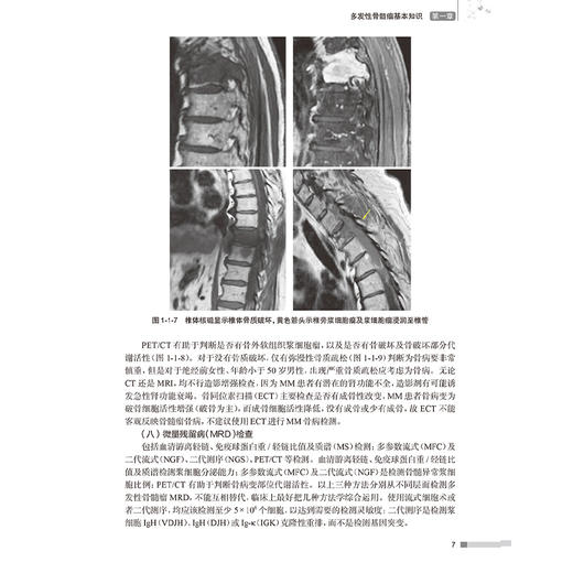 多发性骨髓瘤造血干细胞移植 主编李娟 路瑾等 自体造血干细胞移植后的治疗 移植患者感染的防治 人民卫生出版社9787117362153 商品图4