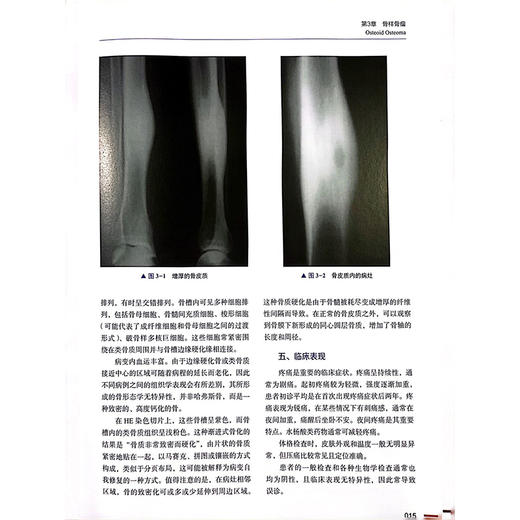 骨肿瘤诊断与治疗 主译高嵩涛 牛科润 成骨性骨肿瘤 成软骨性骨肿瘤 血管来源骨肿瘤 尤因肉瘤 中国科学技术出版社9787523607190 商品图3