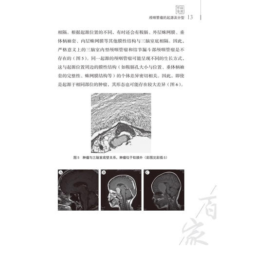 颅咽管瘤2024观点 主编 漆松涛 刘忆 颅咽管瘤命名的演变及分类 神经病学与精神病学 医学书籍 科学技术文献出版社9787523517192 商品图2