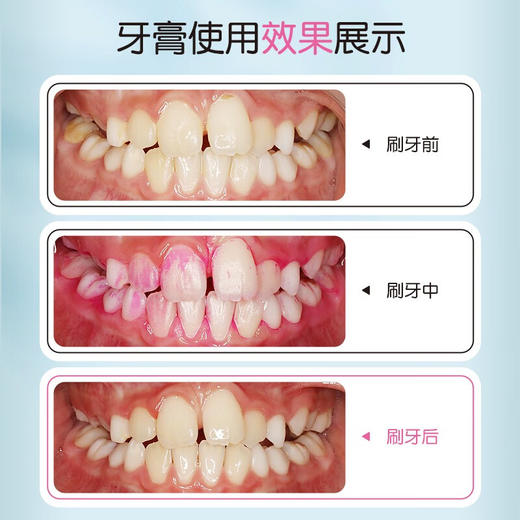 牙高医生儿童菌斑可视牙膏60g 菌斑防蛀牙虫牙龋齿水果草莓味含氟防蛀牙膏 商品图4