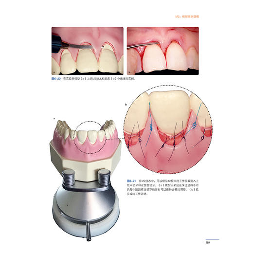 牙周及种植体周显微整形外科图谱 牙周显微外科上皮下结缔组织移植显微外科方法微笑技术曲哲主译9787559133939辽宁科学技术出版社 商品图4