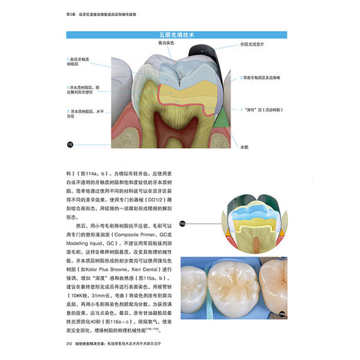 全2册微创修复解决方案2本套装非龋性牙体硬组织疾病 牙体修复概论 传统粘接固位修复体 刘擎主译9787559135346辽宁科学技术出版社 商品图4