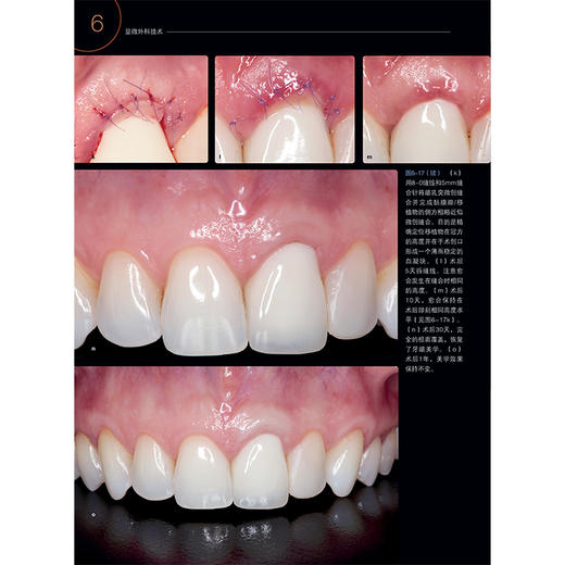 牙周及种植体周显微整形外科图谱 牙周显微外科上皮下结缔组织移植显微外科方法微笑技术曲哲主译9787559133939辽宁科学技术出版社 商品图3