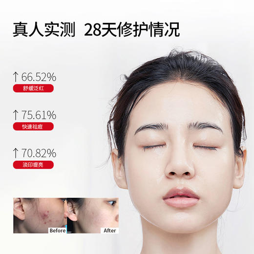 【铂鱼祛痘1.0 清洁控油祛痘】铂鱼祛痘修护洁面慕斯 水 精华  肌肤痤疮粉刺 毛孔粗大 痘印 械字号医用胶原蛋白医美补水舒缓泛红敏感修复T 商品图5