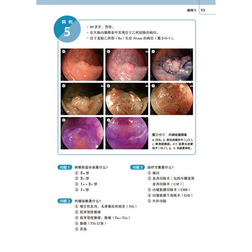内镜医生和技师的大肠肿瘤诊疗实战病例集 商品图4