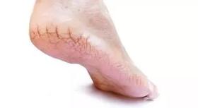  脚后跟干裂,小腿长“鱼鳞”,你以为皮肤缺水？ 错，病根在这里！ 