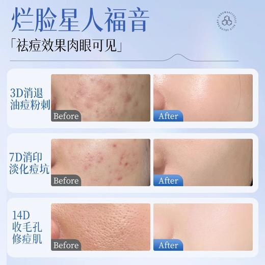 【早晚1支 祛痘不留印】水杨酸祛痘精华1.5ml×30支/盒装#水杨酸祛痘精华液次抛修复淡化痘印疤面部去闭口粉刺黑头收缩毛孔 商品图2