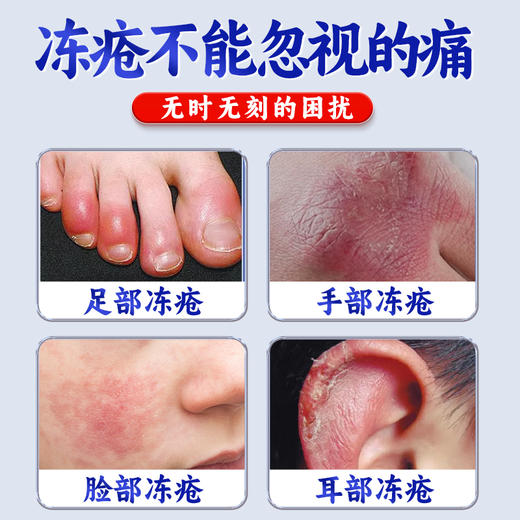 疯抢中！【香港老字号 秋冬手足冻疮克星】百年传承！宝芝林医用冻疮软膏 皮肤皲裂 反复冻疮 干燥开裂 滋润皮肤护理软膏 商品图1