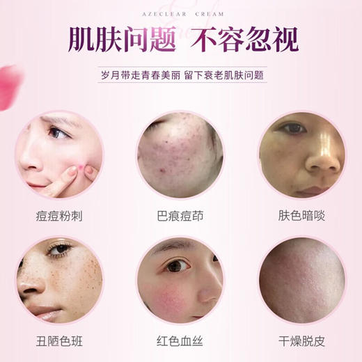 AZECLEAR Cream澳洲肤润康20%壬二酸软膏凝胶乳膏30g杜鹃花酸乳霜祛痘美白祛斑  30g/支 商品图1