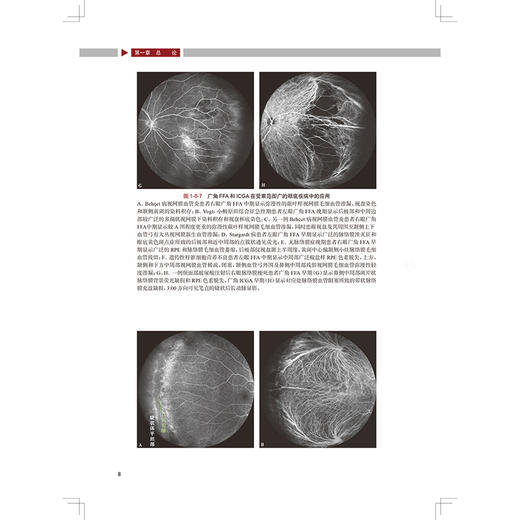 图说广角眼底影像 主编文峰 张雄泽 吉宇莹 遗传性视网膜脉络膜病变 眼底炎症与感染 视网膜血管性疾病9787117370912人民卫生出版社 商品图3