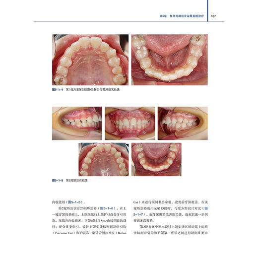 替牙列期矫治实践 基于无托槽隐形矫治系统的诊疗策略与流程 颅颌牙列生长发育变化概述 著刘思琦9787559137982辽宁科学技术出版社 商品图4