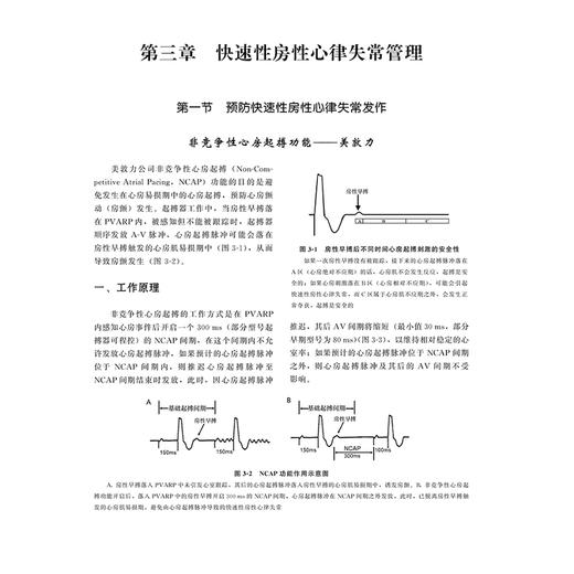 心脏起搏器现代功能详解第2版 吉亚军 陈顾江等主编 心房滞后功能 起搏器介导性心动过速干预功能9787565932779北京大学医学出版社 商品图4
