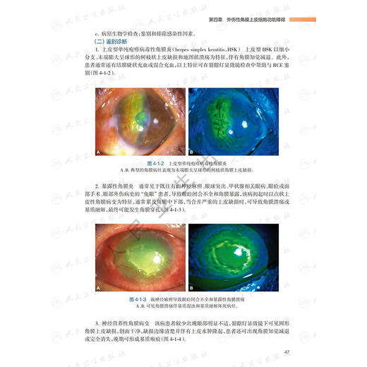 角膜上皮细胞功能障碍诊疗图解 眼表疾病临床系列 王华 孙旭光等编 先天性外伤性药源性临床眼科学诊断防治病例 人民卫生出版社 商品图4