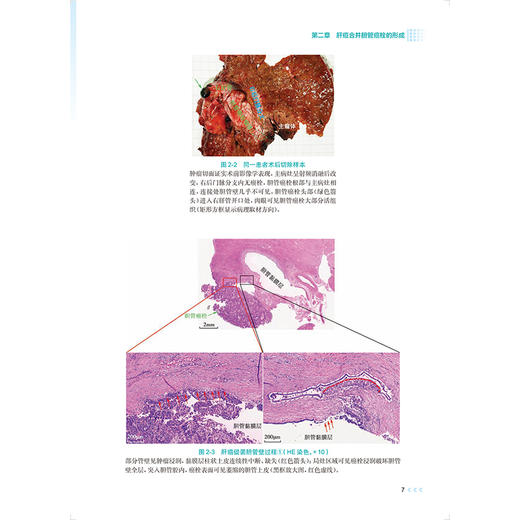 肝癌合并胆管癌栓诊治 严茂林 程树群 肝胆癌影像图片示意图临床外科学手术 经导管肝动脉化疗栓塞内支架置入 人民卫生出版社 商品图4