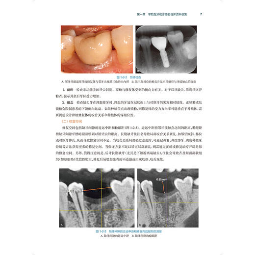单颗后牙种植修复决策路径及操作实践 主编陈泽涛 黄宝鑫 单颗后牙初诊患者临床资料收集 口腔科学 9787117368254人民卫生出版社 商品图4