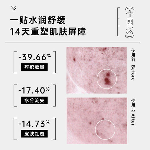 【品牌直发】美卿胶原祛痘面膜 商品图1