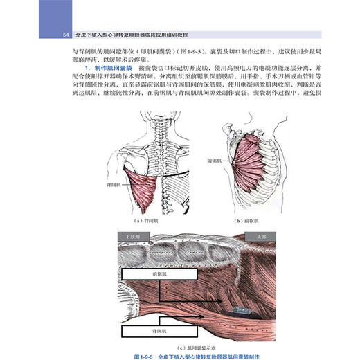 全皮下植入型心律转复除颤器临床应用培训教程 心脏起搏 心血管内科 陈样新 牛红霞 李耀东 中华医学电子音像出版社9787830054090 商品图4