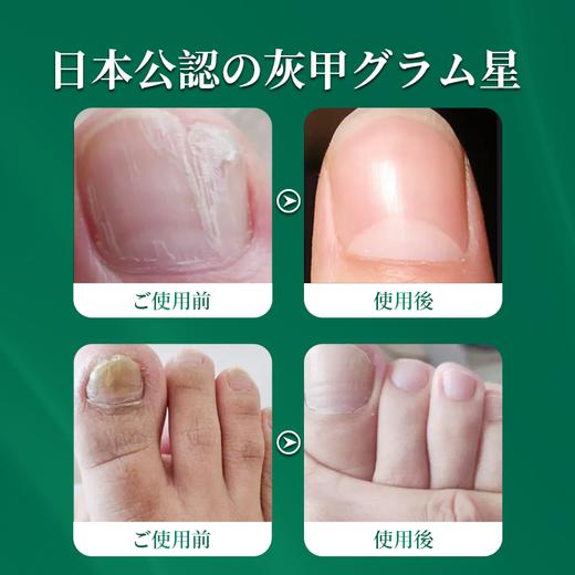 日本高井灰甲贴 无痛高效速清灰甲、告别反复，长出亮白新指甲 商品图2