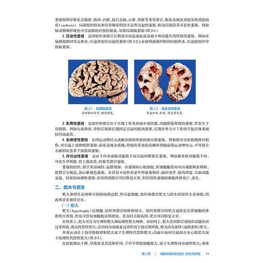 病理学与病理生理学 第9版十四五规划教材 全国高等职业教育专科教材 张忠 邓良超编供临床医学专业用9787117371407人民卫生出版社 商品图4