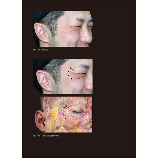 面部表情肌解剖及肉毒毒素注射技巧 附视频 罗盛康 金熙真编 额肌解剖 眉间复合体解剖 提上唇鼻翼肌9787117357180人民卫生出版社 商品图3