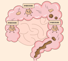  一发现就是中晚期肠癌？其实一个方法就能避免！ 