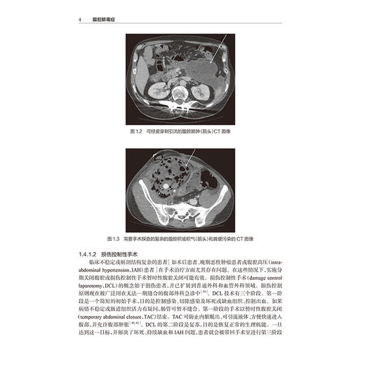 腹腔脓毒症 急性手术和创伤医疗热点问题 段军 郭丰 腹腔脓毒症诊治的内科 外科 麻醉科和ICU医生提供了很好的教材人民卫生出版社 商品图4