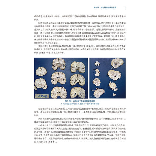 中枢神经系统退行性疾病临床神经病理学 王鲁宁等编 供从事神经科 老年科 精神科神经影像等专业的临床医师及相关基础研究人员参考 商品图4