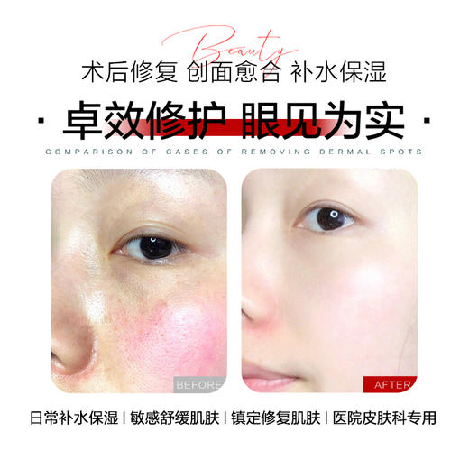 【买一发三】惜美时医用重组III型人源化胶原蛋白敷料（面膜） 商品图4