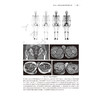 骨质疏松症影像诊断与骨密度测量 程晓光主编 详细介绍骨质疏松症的各种影像检查技术X线平片CTMRI 9787117355162人民卫生出版社 商品缩略图4