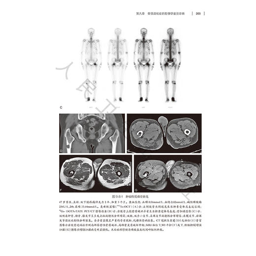 骨质疏松症影像诊断与骨密度测量 程晓光主编 详细介绍骨质疏松症的各种影像检查技术X线平片CTMRI 9787117355162人民卫生出版社 商品图4