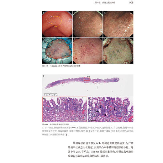 基于组织学分类的早期胃癌病理和内镜图谱 陆新良 许晶虹编 系统阐述各种病理亚型早期胃癌内镜病理特征9787117366021人民卫生出版社 商品图4