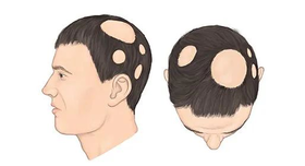 英年早秃 | 脱发日益年轻化？不要做“人间蒲公英”！