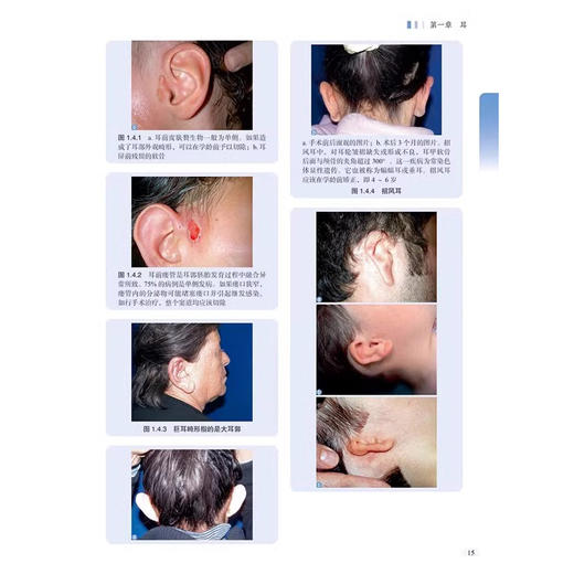 耳鼻喉科诊断指南 第2二版 T.梅丁·奥兹坎等编 耳部解剖 前庭解剖 耳鼻喉科检查 耳郭 外耳道 分泌性中耳炎 科学技术文献出版社 商品图4