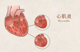 甲流后出现胸闷、心慌等症状，是心肌炎的前兆吗？