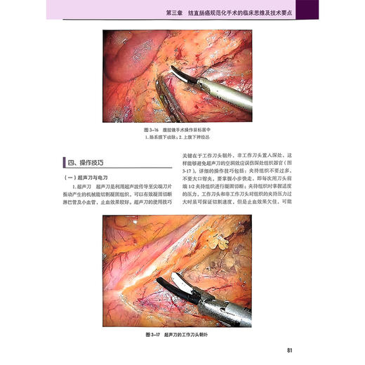 全2册 结直肠癌规范化手术配视频 + 胃癌规范化手术配视频2本 季加孚 步召德 结直肠临床应用解剖 常用术式规范操作方法 外科手术  商品图4
