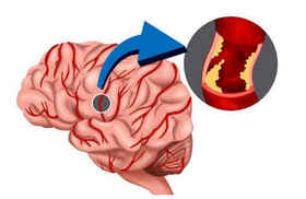 这2处发麻或是脑梗前兆，冬天正是高发期，一定要重视！