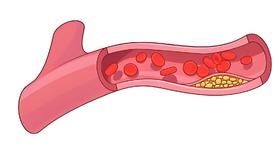  血管多强，生命就多长！做好 4 件事，让血管老得慢一点 