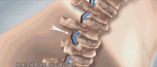 【泰国 JXXINLIN腰间盘突出】专攻腰间盘突出、腰椎酸痛 抹一抹!自带防伪  通络止痛，缓解损伤肿痛 守护腰椎健康!!全家都能一起用! 商品图1