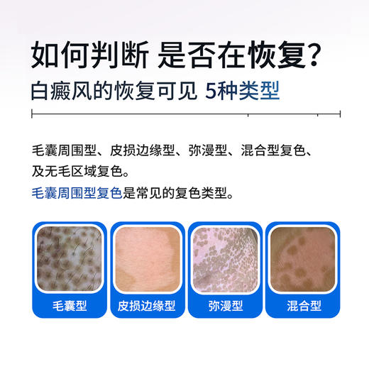 【插电款】希格玛家用20mW/cm²强度308白癜风光疗仪银屑病牛皮藓紫外线SQ308PHRFF【适应症：白癜风、银屑病】 商品图5