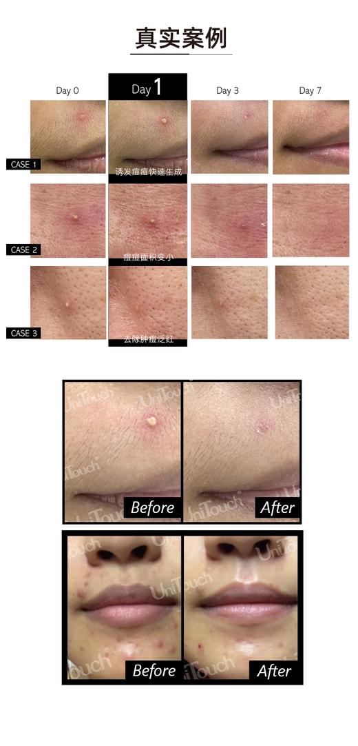 【稀缺祛痘神器】壬二酸UniTouch祛痘滚珠｜一日痘退散｜祛痘绝绝子｜预防和淡化痘印｜国外丝芙兰爆品｜使用感满分高级｜SGS人体实验证实 商品图8