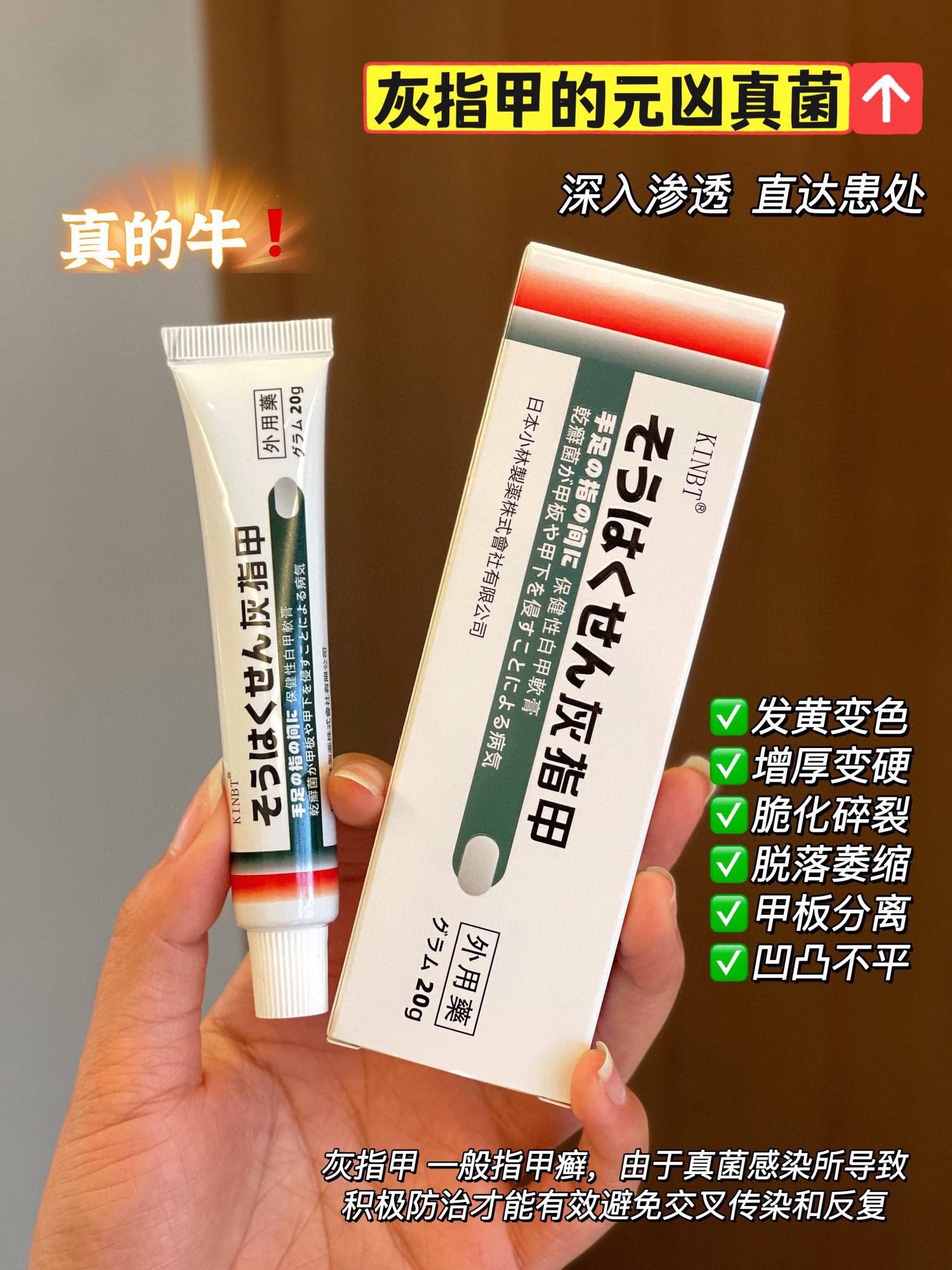 【日本 灰指甲膏】灰指甲“终结者”一抹即消永不复发灰指甲终结者，效果yyds!99%抑菌率-强渗透“长时效靶向渗透，迅速消灭甲内真菌。并减少复发! 专治由甲癣真菌引起灰指甲、厚甲、甲床分离等困扰!