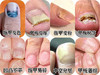 【日本 灰指甲膏】灰指甲“终结者”一抹即消永不复发灰指甲终结者，效果yyds!99%抑菌率-强渗透“长时效靶向渗透，迅速消灭甲内真菌。并减少复发! 专治由甲癣真菌引起灰指甲、厚甲、甲床分离等困扰! 商品缩略图4