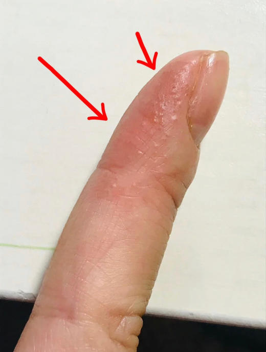 【泰国TH汗疱抑菌乳膏】湿疹皮炎的克星 泰国百年皇室传承配方，对汗疱疹、湿疹、皮炎、牛皮癣、荨麻疹..各种皮肤问题统统都有效!快速止痒“强效抑菌+修复屏障 商品图3