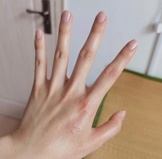 【泰国TH汗疱抑菌乳膏】湿疹皮炎的克星 泰国百年皇室传承配方，对汗疱疹、湿疹、皮炎、牛皮癣、荨麻疹..各种皮肤问题统统都有效!快速止痒“强效抑菌+修复屏障 商品图4