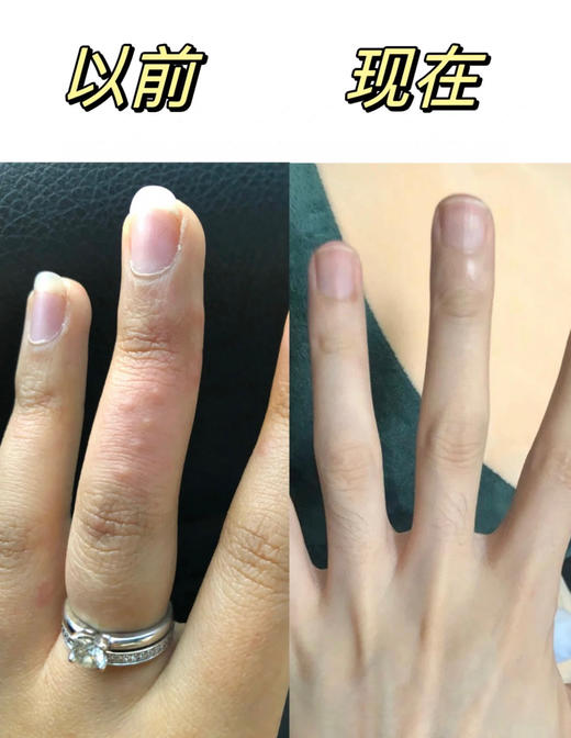 【泰国TH汗疱抑菌乳膏】湿疹皮炎的克星 泰国百年皇室传承配方，对汗疱疹、湿疹、皮炎、牛皮癣、荨麻疹..各种皮肤问题统统都有效!快速止痒“强效抑菌+修复屏障 商品图2