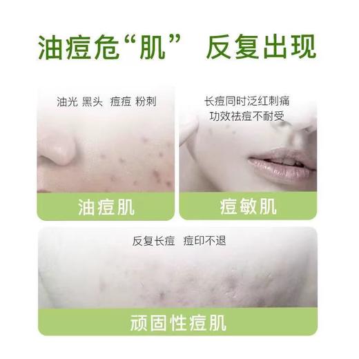 半价优惠，绽姸 控油祛痘平衡水乳 三件装 ，洁面泡沫100g +控油水120ml+控油乳50g（发新包装） 商品图3
