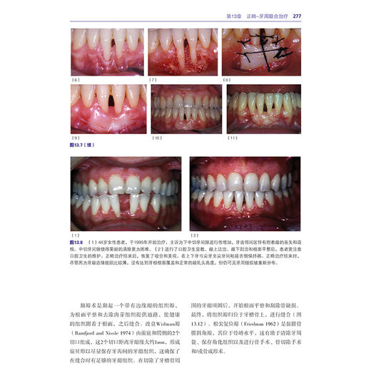成人口腔正畸学 第2二版 厉松译 正畸临床实践治疗成人口腔正畸牙周治疗成人正畸 9787559140357辽宁科学技术出版社 商品图4