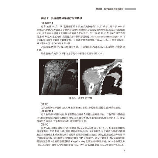 难治性癌痛典型病例评析 黄诚 王昆 通过近100例典型治疗案例 展示难治性癌痛治疗中个体化治疗的特点 癌痛介入治疗技术的合理应用 商品图4
